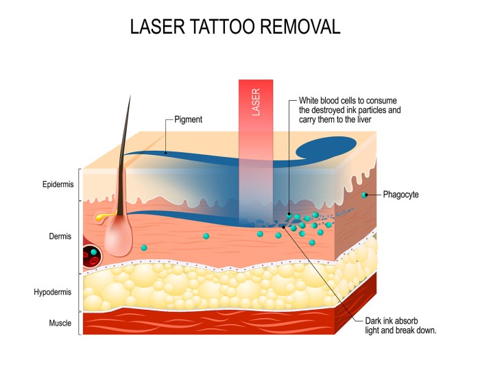 문신 제거 문신 제거